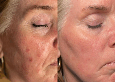 Rosacea & Redness Results