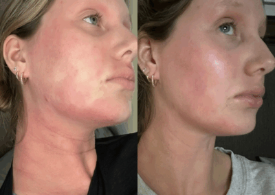 Skin Clarity Results