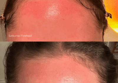 Sunburn Recovery