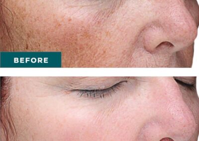 VI Peel before and after Canton GA