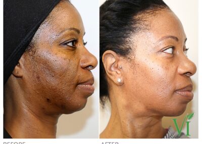 VI Peel before and after Canton GA