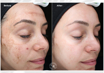 VI Peel before and after Canton GA