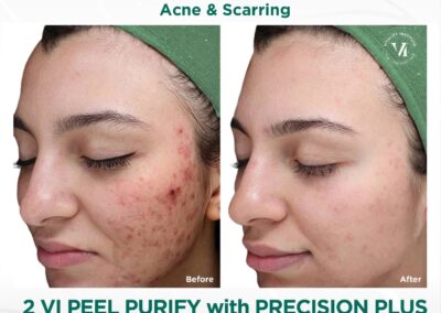 VI Peel before and after Canton GA
