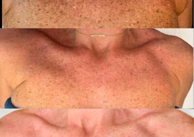 VI Peel before and after Canton GA